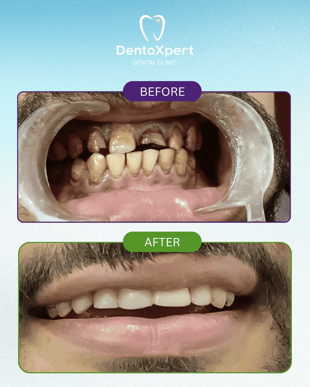 Before and after dental treatment result at DentoXpert Dental Clinic in Thane